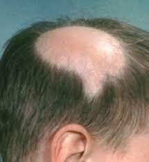The hair loss can occur anywhere on the body — it may involve the scalp hair or hair of eyebrows, eyelashes, or. Alopecia Areata Richmond Dermatology