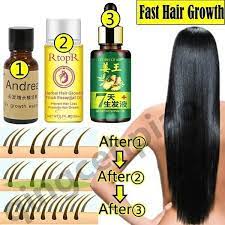 It promotes a healthy scalp, and stops breakage at the ends of the hair, along with stimulating faster hair growth. Say Goodbye To Hair Loss Chinese Herbal Fast Hair Growth Essential Oil Buy At A Low Prices On Joom E Commerce Platform