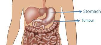 When stomach cancer does cause. Stomach Cancer Treatment Surgery For Stomach Cancer Perth