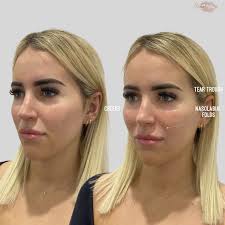 ✨Ｖｏｌｕｍｅ.Ｒｅｓｔｏｒａｔｉｏｎ✨ｗｉｔｈ ｄｅｒｍａｌ ｆｉｌｌｅｒｓ✨ Aim: Restoring natural volume loss  to facial features, to achieve a 'lifted-natural look'. Treatment areas:  Tear troughs, Cheeks and nasolabial folds. Results by: Nurse Lakan ...