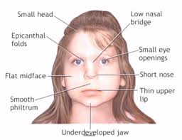 Fetal alcohol syndrome epicanthal folds flat nasal bridge small palpebral fissures upturned nose. Out Of Context Sam O Nella Day 281 Samonellaacademy