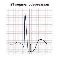 We did not find results for: St Depression Wikipedia