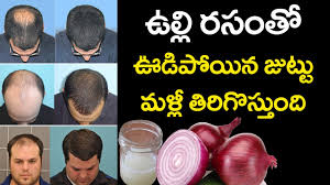 Can onion juice help regrow hair? Shocking Onion Juice Regrows Hair Home Remedies For Hair Growth Best Tips Vtube Telugu Youtube