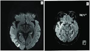 Neonatal hsv encephalitis usually results from acquisition of type 2 virus during passage through the birth canal of a mother the greatest diagnostic difficulty is distinguishing between hsv encephalitis and brain abscess. A And B Brain Mri Images At Time Of Relapse Of Hsv Encephalitis A Download Scientific Diagram