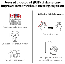 Image result for Thalamotomy