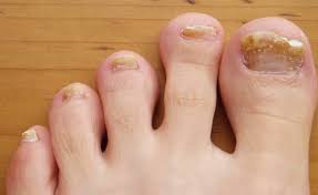 Image result for Koilonychia feet