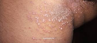 The groin is the superficial area where the trunk and the legs meet; Ask A Dermatologist Online For Red Spots On Groin Area