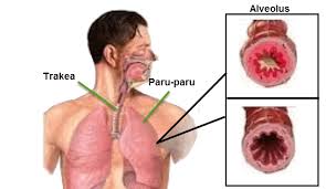 Penyebab Dan Cara Pencegahan Penyakit Pernapasan Mikirbae Com
