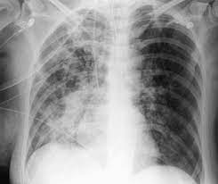 Asymmetrical Distribution Of Airspace Opacification In A Patient With Pulmonary Oedema There Is Patchy Opacification In The Right Lung Wi Oedema Lunges Thorax