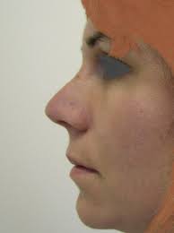 Nasenkorrektur Rhinoplastik In Prag Karlsbad Tschechien Ausland Klinik Uem