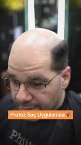 Alper Aslan Protez Saç