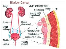 Blood in urine (hematuria), which may cause urine to appear bright red or cola colored, though sometimes the urine appears normal and blood is detected on a lab test Bladder Cancer Signs Of Bladder Cancer Kimaja Farwani