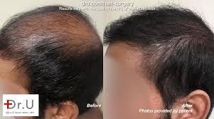 Prp hair treatment los angeles. Dr Umar Hair Transplant Reviews Los Angeles 6 Hairsite Com