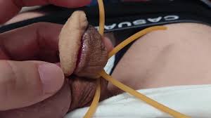 Penectomy: glansectomy? - ThisVid.com