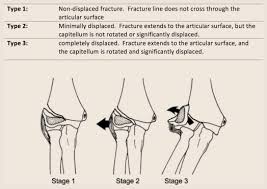 Image result for Lateral Condyle Fracture