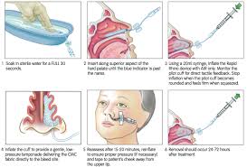 Image result for Epistaxis