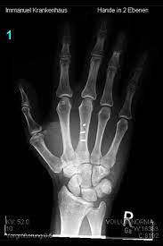 Knochenbruche An Hand Und Fingern Obere Extremitat Hand Und Mikrochirurgie Immanuel Krankenhaus Berlin