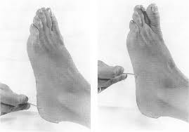 Image result for Babinski Reflex