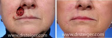Since the skin cancer was not completely contained within the boundaries of the nostril, the reconstructive process more difficult. Pictures Of Skin Cancer Reconstruction