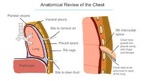 Image result for Small Caliber Chest Tube