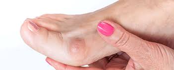 Basically, you should always have foot pain checked out if it persists. 11 Most Common Foot Lumps And Bumps Explained University Foot And Ankle Institute Los Angeles