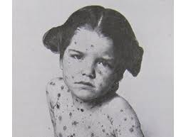 Do not give aspirin to children under 16. Chickenpox Varicella History Of Vaccines