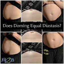 What does diastasis recti feel like. Does Doming Equal Diastasis Recti Fit2b Studio
