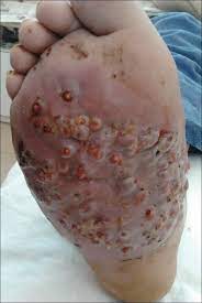 Find the perfect madura foot stock photos and editorial news pictures from getty images. Eumycetoma Pedis In An Albanian Farmer Mdedge Dermatology