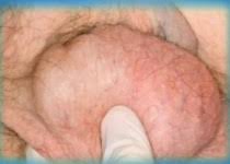 12 Testis Tumorlerinin Seyri Nasildir Antalya Uroloji Doc Dr Mehmet Sarier