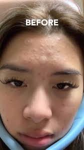 Effaclar Serum ลดสิวอุดตันที่ดีที่สุด