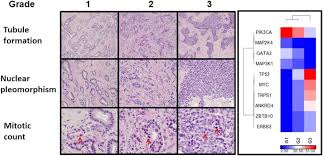 Breast cancer is not just one disease, but rather is a general term used to describe a number of different types of cancers that occur in the breast. A Microscopic Landscape Of The Invasive Breast Cancer Genome Scientific Reports