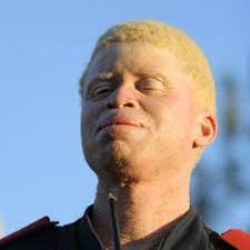 Maybe you would like to learn more about one of these? What Causes Albinism Scientific American