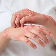Image result for dermatitis contacta