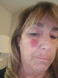 Hi my dermatologist wants to start humira but I'm worried about this cost.  I do have insurance but still not sure what to expect. Any one have an idea  of the price