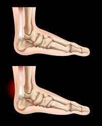 Fabian explaining the ligaments and tendons of the foot. Human Feet And Injury In Tendon 303709 Vector Art At Vecteezy