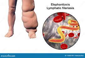 一个人的腿有象皮病的，淋巴丝虫病库存例证. 插画包括有流体, 健康, 准确, 肢体, 系统, 情况- 116205199