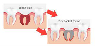 How do you know if you get dry socket. How To Tell If You Have A Dry Socket Dental Dorks