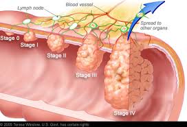It is not a comprehensive list of all cancer awareness dates. March Is Colorectal Cancer Awareness Month