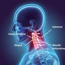On ressent une douleur aux cervicales qui remonte dans la tête. Hernie Discale Cervicale Nevralgie Cervico Brachiale Chirurgie Du Rachis