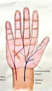 From ancient greek ἀναστόμωσις (anastómōsis), from ἀναστομόω (anastomóō, furnish with a mouth or outlet). Electrodiagnostic Description Of A Rare Variant Of Berrettini Anastomois A Case Report Sciencedirect