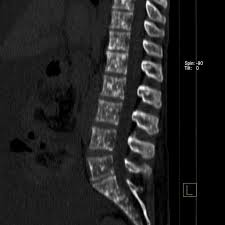 This usually includes the lungs, liver, bones other nonspecific systemic symptoms of metastatic breast cancer can include fatigue, weight loss, and poor appetite, but it's important to. Spinal Metastases From Breast Cancer Radiology Case Radiopaedia Org