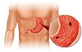 Illustration of stomach disorders gastric ulcer, gastritis, heartburn. Peptic Or Stomach Ulcer Treatment Symptoms And Home Remedies Centralviral