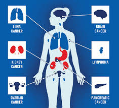 Pancreatic cancer is always called silent cancer for the reason that it's believed that its initial symptoms can either be vague or unrecognized or both. World Thrombosis Day Cancer Associated Thrombosis
