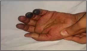 The use of automatic lancets with disposable needles should theoretically reduce the risk of infection. Digital Gangrene In Patients With Sepsis Semantic Scholar