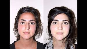 Middle Eastern & Mediterranean Female Rhinoplasty NYC Before & After Dr.  Sam Rizk