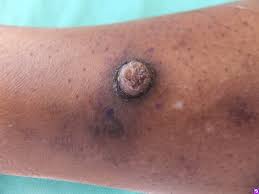 They sidewind into friendships and avoid full frontal engagement until there's absolute trust. Disease Management Nonmelanoma Skin Cancer