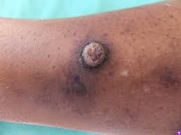 skin cancer can be cured if it&#x27;s found and treated early. Disease Management Nonmelanoma Skin Cancer