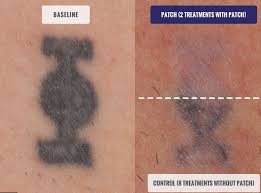 Accelerated Tattoo Removal Treatment Vanish Laser Clinic Alexandria Va