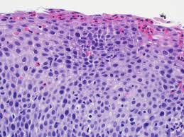 Abstract herpes simplex virus (hsv) is a common cause of infectious esophagitis. Pathology Outlines Eosinophilic Esophagitis