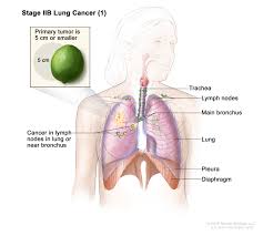 Non Small Cell Lung Cancer Treatment Pdq Pdq Cancer